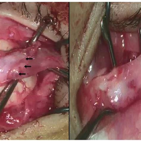 Intraoperative Appearance Of Two Forms Of Stretched Scar At Lateral