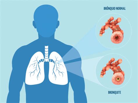 Bronquite Cr Nica E Aguda O Que Sintomas E Tratamento Cliquefarma