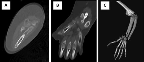 A Sagittal Ct Of The Elbow Ulnar Duplication With Different Height