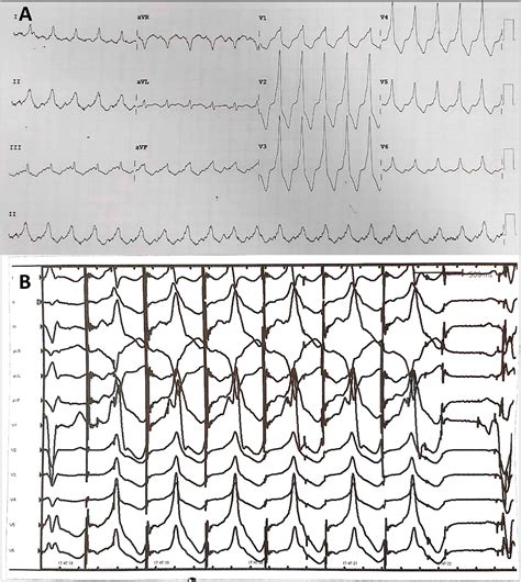 PO 03 098 VENTRICULAR TACHYCARDIA STORM SUBSTRATE IDENTIFIED WITH