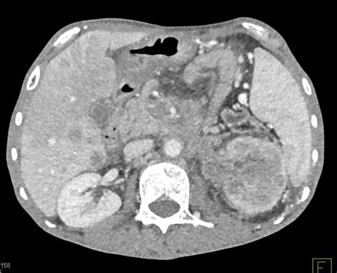 Pancreatic Cancer With Liver Metastases Adenopathy And Carcinomatosis