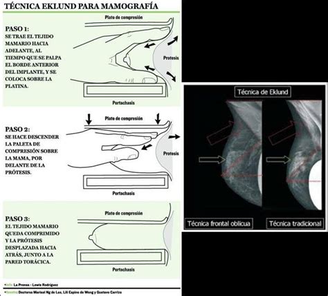 Mamografía en pacientes portadoras de prótesis mamarias La técnica