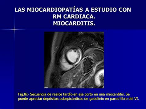 Las MiocardiopatÍas A Estudio Con Rm Cardiaca Ppt Descargar