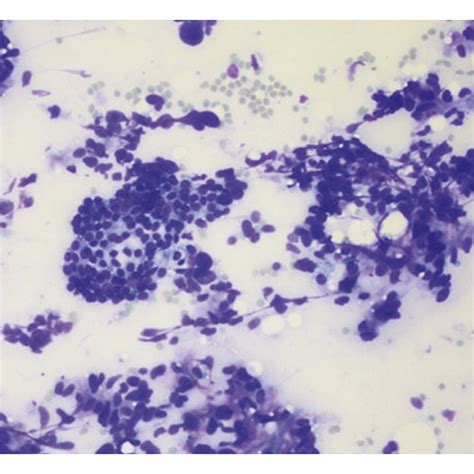 Thyroid Nodule Fnab Diff Quick Stain With Marked Cellularity Of Download Scientific Diagram