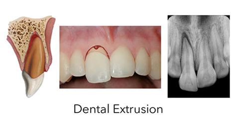 What Pray Tell Is A Dental Extrusion Anywaybasically An Extrusion Is A Loose Tooth Where