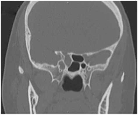 Pre-operative coronal T2-weighted MRI showing CSF leak without ...