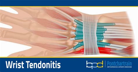Wrist Tendonitis Brandon P Donnelly Md
