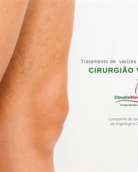 Dr Claudia Stein Cirurgia Vascular E Linfologia Curitiba Pr