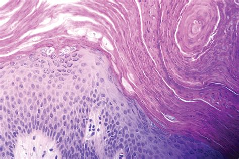 Granular Parakeratosis | MDedge Dermatology