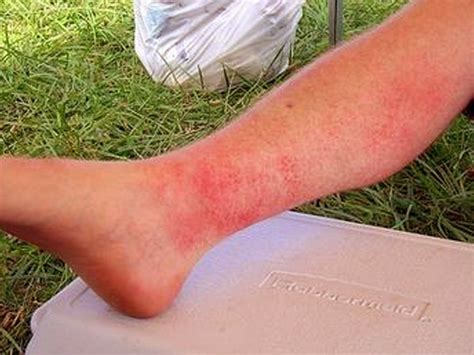 Sun Poisoning Pictures Symptoms Causes Treatment February