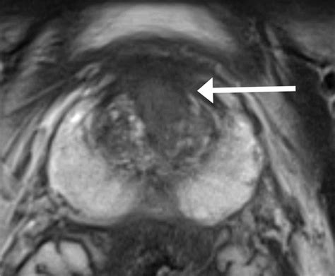 Mri Guided Focused Ultrasound Ablation For Localized Intermediate Risk