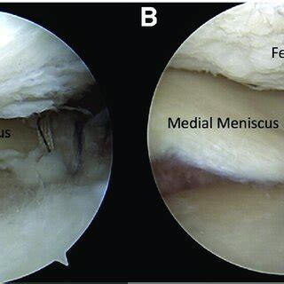 Arthroscopic Image Of A Left Knee With A 30 Arthroscope Viewing From A