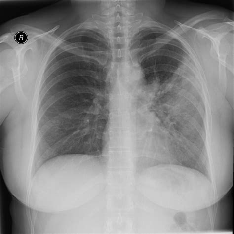 Atelectasis Vs Pneumonia Chest X Ray