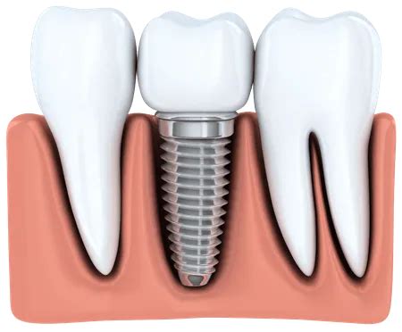 The Recovery Process Associated with Dental Implants