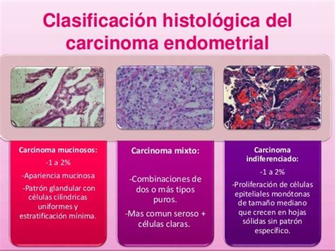 Cáncer De Endometrio