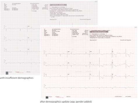 Electrocardiógrafo de 12 canales BeneHeart R12 Mindray