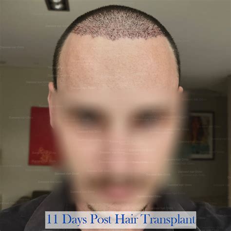 Hair Transplant In Turkey For An Aussie Diamond Hair Clinic Dr