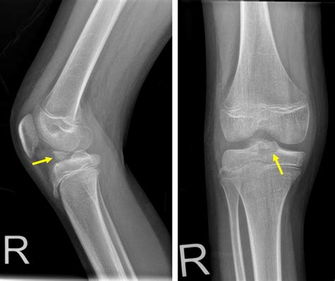 Avulsion Fracture Of Acl Radiology Cases