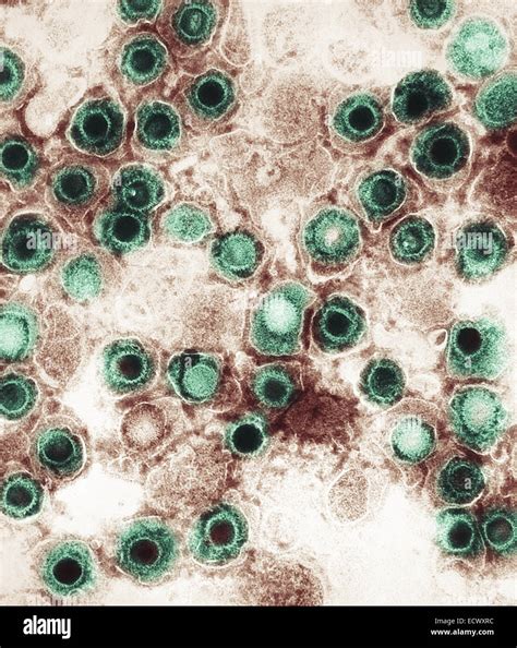 Herpes Simplex Virus Génital Banque De Photographies Et Dimages à