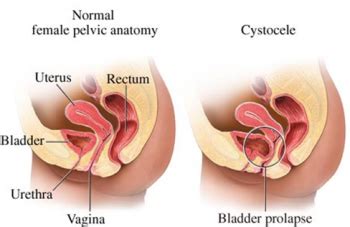 What Is Prolapse Pure Pelvic Health