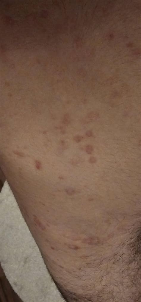 itchy spots  started showing     skin