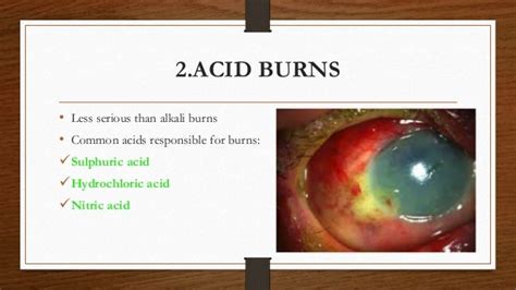 Chemical Injuries Of The Eye