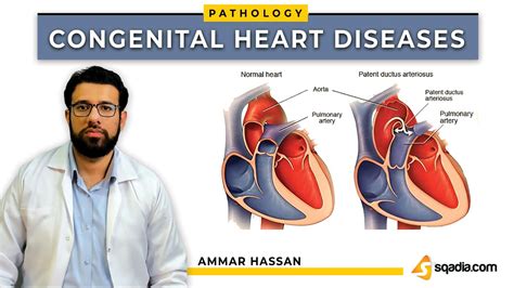 Congenital Heart Diseases Introduction And Classification Pathology