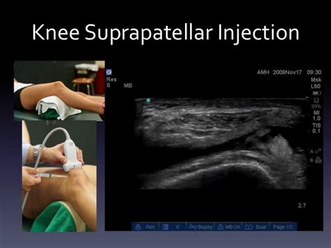 Ultrasound Guided Injections Lower Extremity