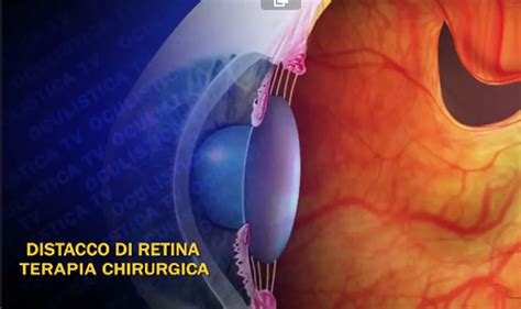 DISTACCO DI RETINA E TERAPIA CHIRURGICA VITRECTOMIA OCULISTICATV