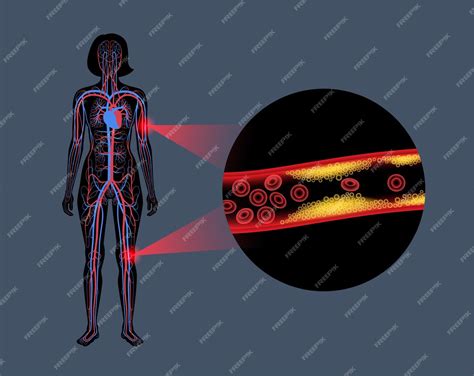 Premium Vector Peripheral Artery Disease