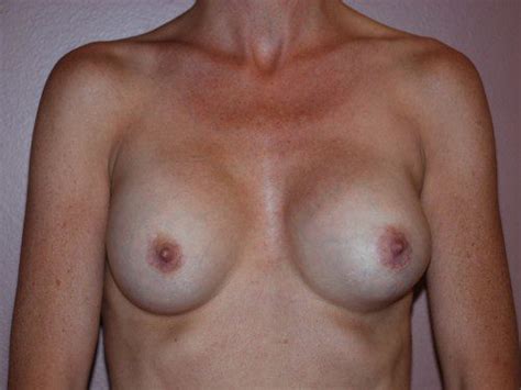 Breast Revision Before After Gallery Allen Doezie Md Facs