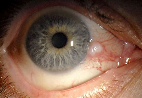 Conjunctival Intraepithelial Neoplasia