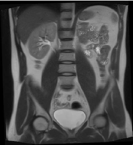 Figure From Unilateral Left Renal Agenesis Associated With Congenital