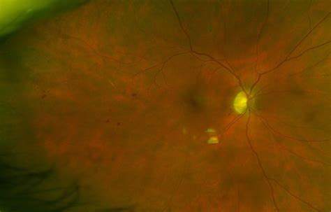 Branch Retinal Vein Occlusion - Associated Retinal Consultants P.C.