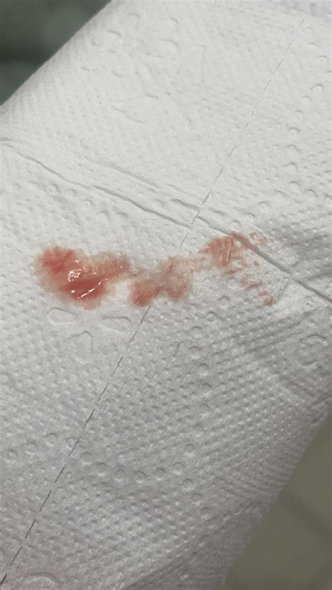 Weird Bump Draining Stinky Blood : r/medical