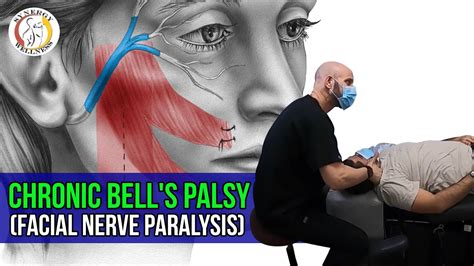 Chronic Bells Palsy Facial Nerve Paralysis Helped By Dr Kulla Synergy Wellness Chiropractic