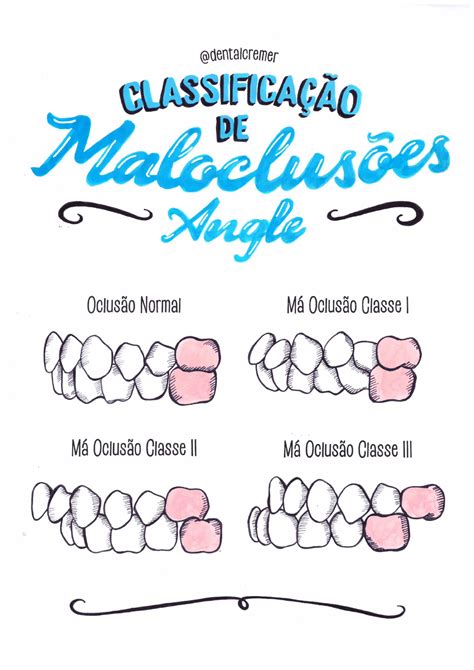 Classificação de Maloclusões Angle Ortodontia e Ortopedia I