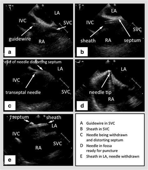 TEE Images During Transseptal Puncture TEE Images In A Bicaval View