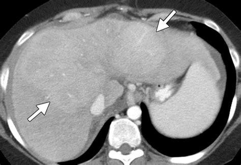 Hematologic Malignancies Of The Liver Spectrum Of Disease Radiographics