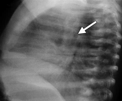 Airp Best Cases In Radiologic Pathologic Correlation Type 2 Congenital Cystic Adenomatoid