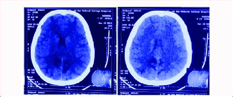 And 2 Ct Brain Showing Bilateral Diffuse Cerebral Edema Involving Download Scientific Diagram