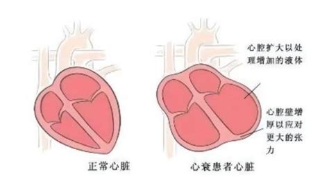 甲亢性心脏病与甲减性心脏病有什么不同危害大吗 知乎