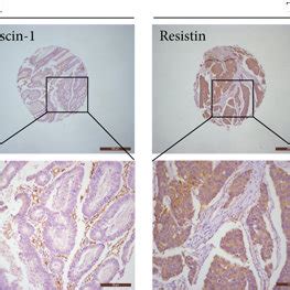 A Tendency Of Positive Protein Levels Between Resistin And Fascin 1 In