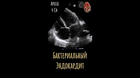 БАКТЕРИАЛЬНЫЙ ЭНДОКАРДИТ. ВЕГЕТАЦИИ НА МИТРАЛЬНОМ И АОРТАЛЬНОМ КЛАПАНАХ ...