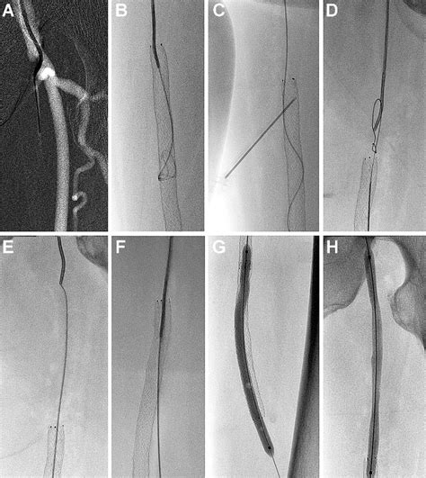 Stent Puncture For Recanalization Of Occluded Superficial Femoral