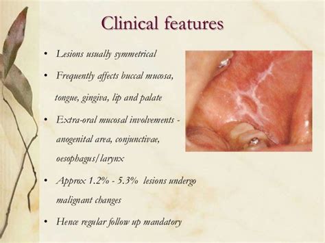 Oral Precancerous Lesions