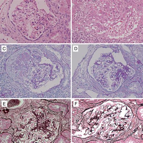 Figure2 Light Microscopic Analysis Of The Renal Biopsy Specimen Of 10