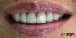 Dise O De Sonrisas Cl Nica De Est Tica Dental Dentart Las Condes