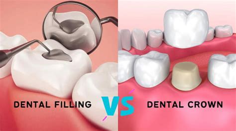 Fillings Vs Crowns Which One Do You Need Dentist For Life