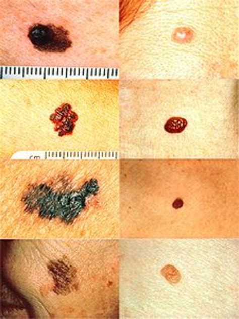 Malignant Cancerous Moles What Are The Signs Detection Symptoms And Cures Of Melanoma